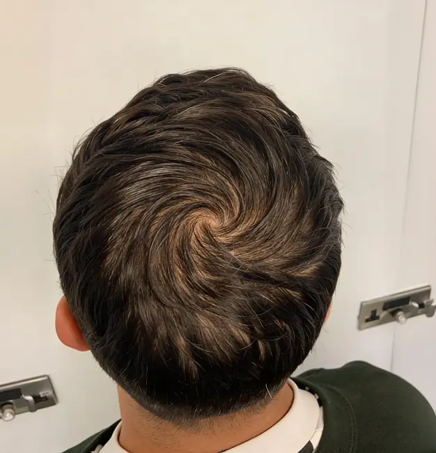How Hair Regenerative Therapy Works