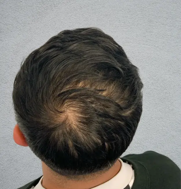 Hair Restoration